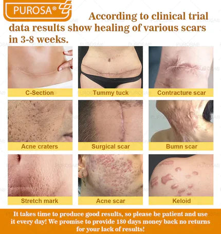 🐝PUROSA® Bee Venom Skin Treatment Cream, Anti-aging, Hydrating, Skin Repair, Even Tone, Acne and Dark Spot Treatment, Wart and Mole Removal, Psoriasis Relief